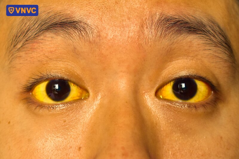 người bệnh bị vàng da vàng mắt