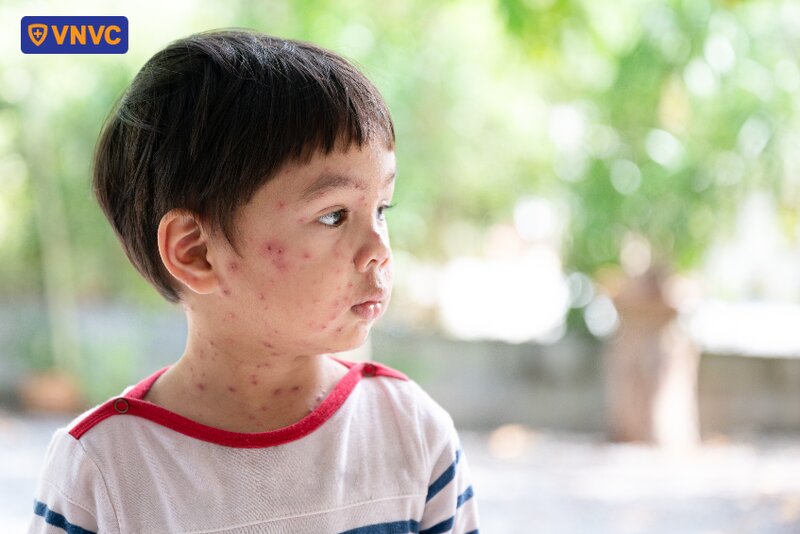 trẻ bị nổi thủy đậu đầy da