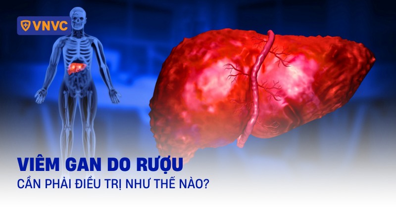 viêm gan do rượu