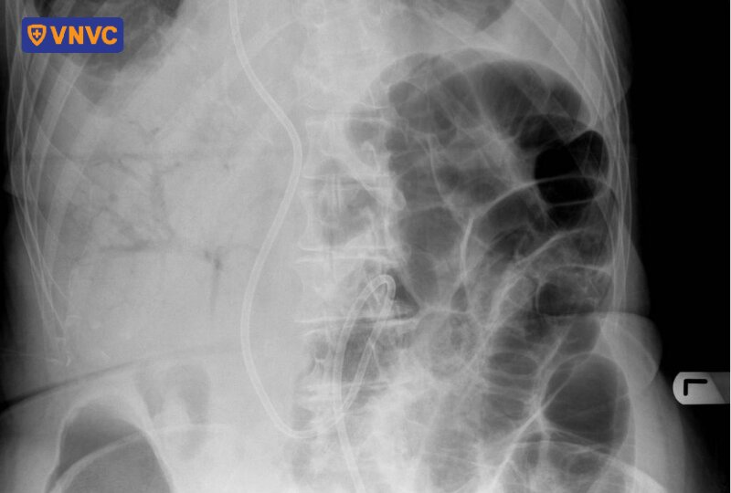 ảnh khí tĩnh mạch cửa trên xquang