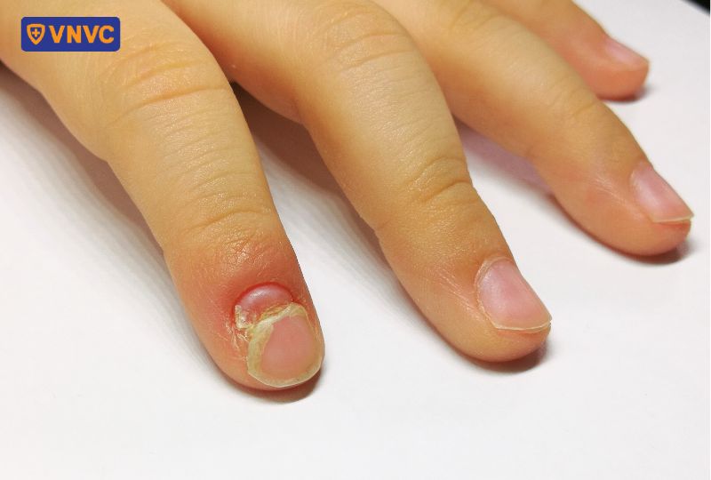bong móng không gây đau