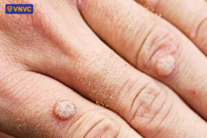 mụn cóc ở tay