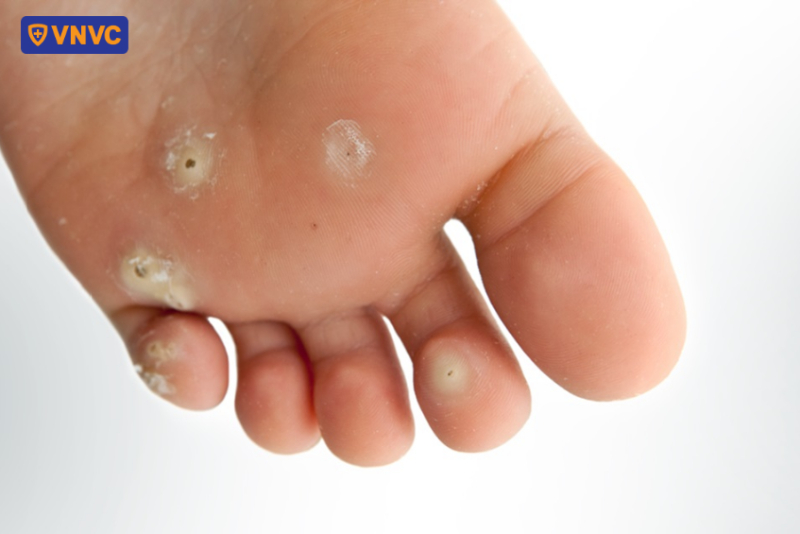 mụn cóc ở lòng bàn chân