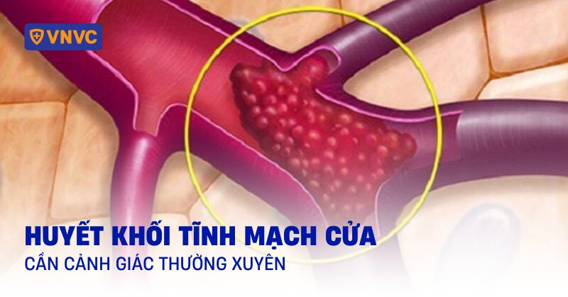 huyết khối tĩnh mạch cửa