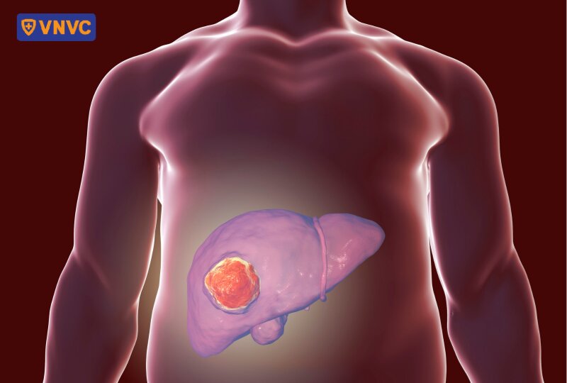 khối u trong gan