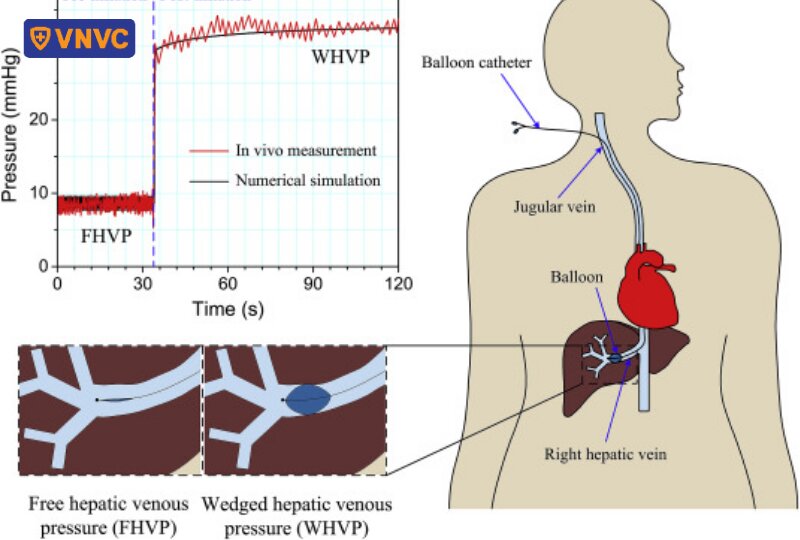 minh họa vị trí tĩnh mạch gan có áp lực cao