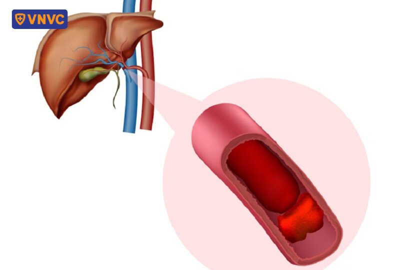 mô phỏng khối máu đông trong mạch gan