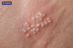 mụn cóc do virus hpv gây ra