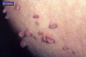 mụn cóc mọc ở nách