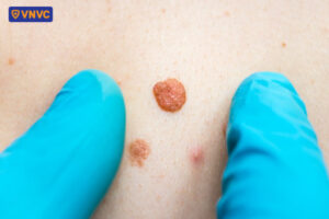 mun cóc mọc ở vùng sinh dục