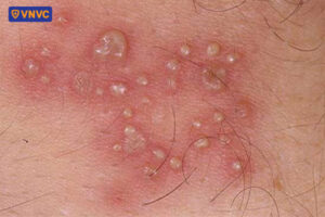 mụn rộp chảy dịch gây ngứa