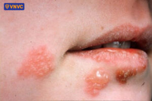 mụn rộp lan rộng