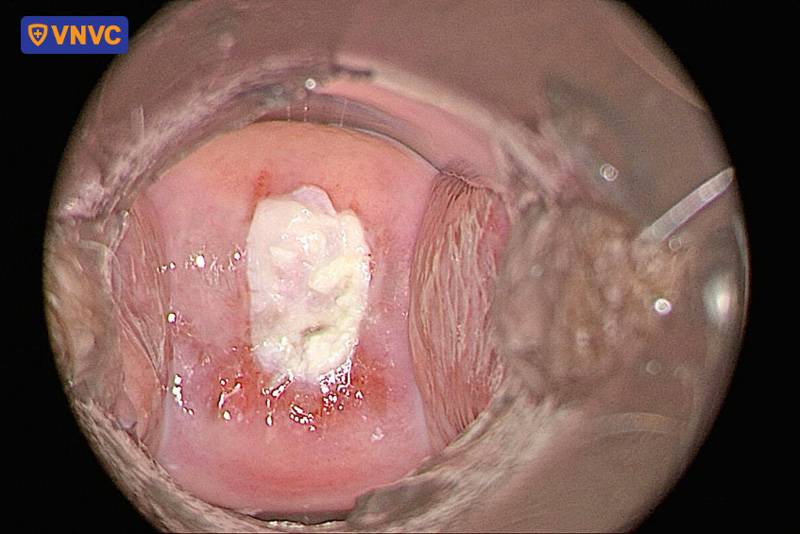 nội soi thấy vệt trắng cổ tử cung
