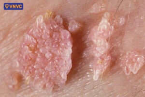 nốt sùi phát triển thành cụm