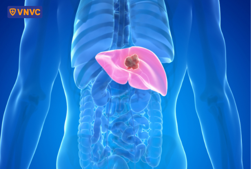 nút mạch gan can thiệp chọn lọc đối với khối u ở gan