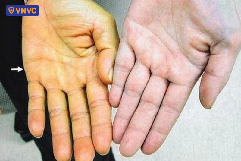 vàng da ở lòng bàn tay