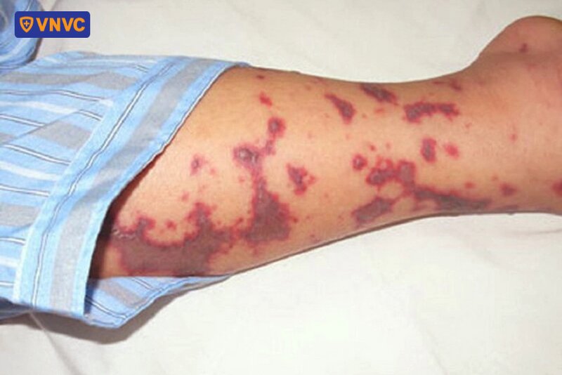 vết sang thương trên chân