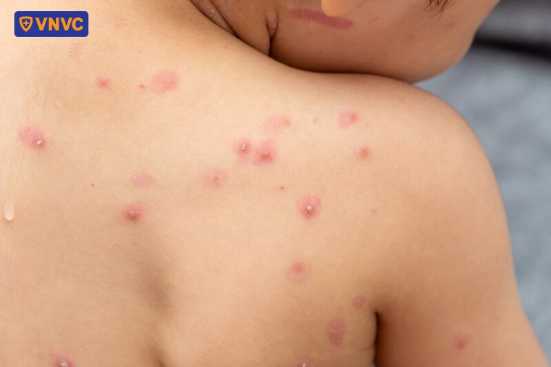 vết thủy đậu mọc khắp da