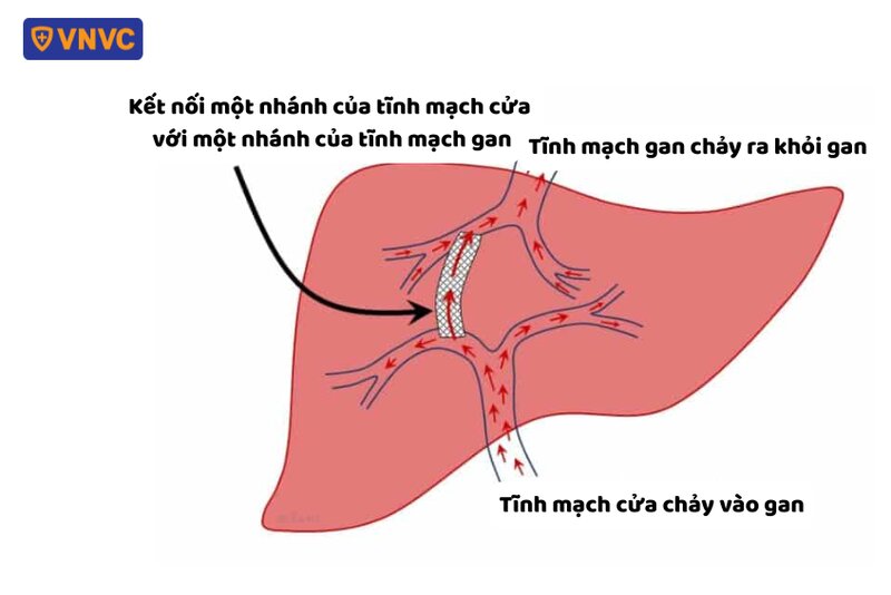 vị trí đặt shunt tạo đường thông tĩnh mạch cửa chủ
