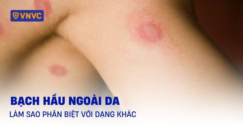 bạch hầu ngoài da