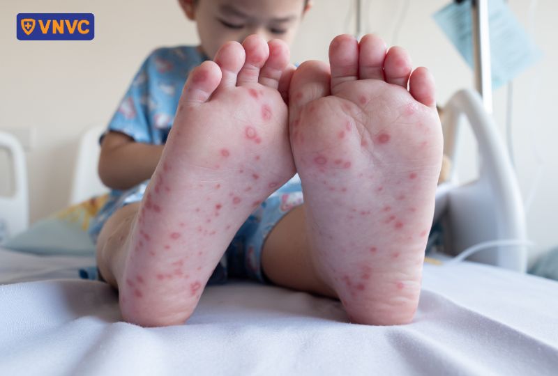 ban đỏ mọc nhiều ở chân trẻ