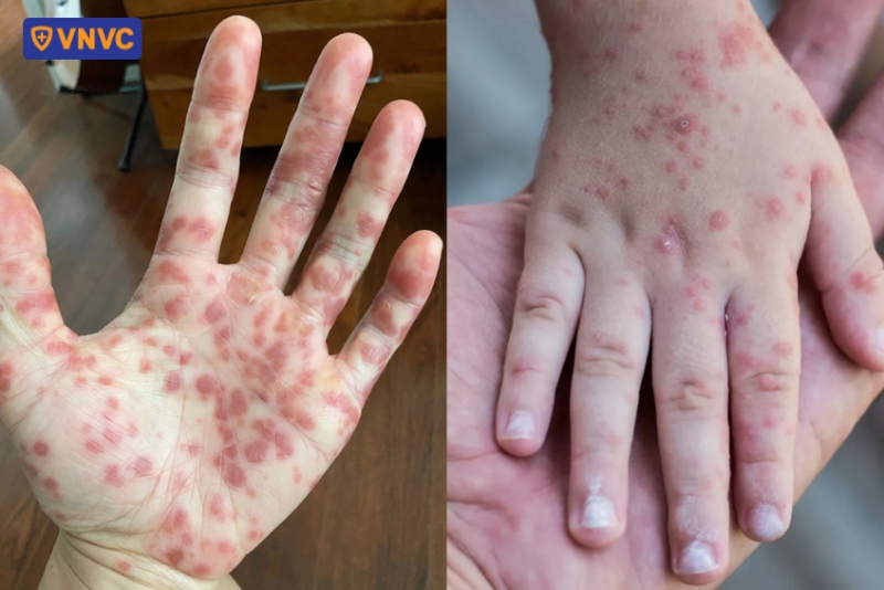 bàn tay bị nổi thủy đậu