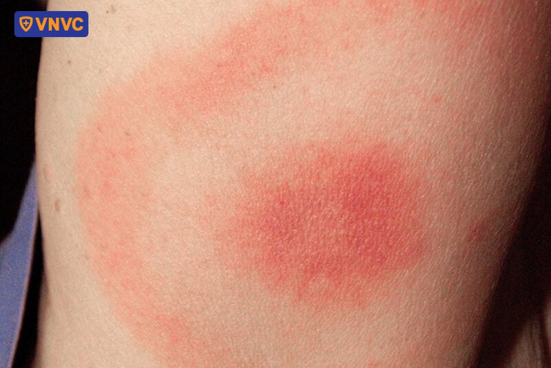 bị sưng ngứa sau tiêm uốn ván