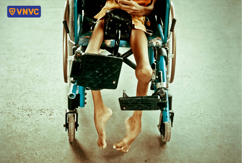 biểu hiện của bệnh bại liệt toàn thân