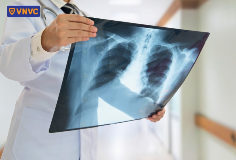 chụp x quang chẩn đoán phổi