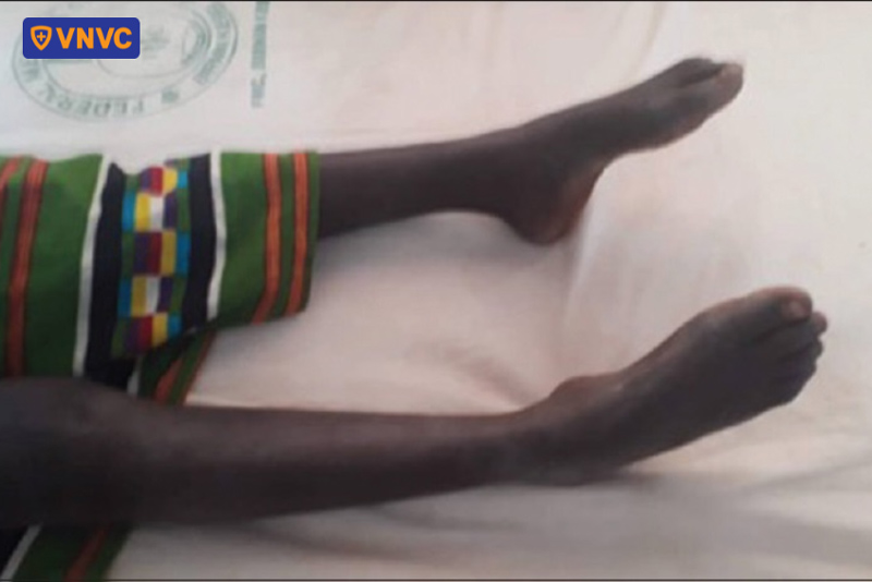 co cứng chân do uốn ván