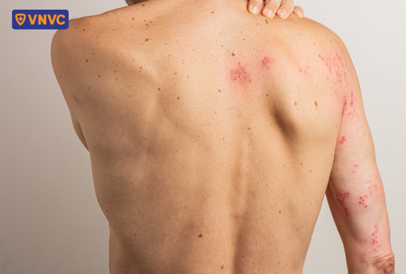 giời leo trên lưng