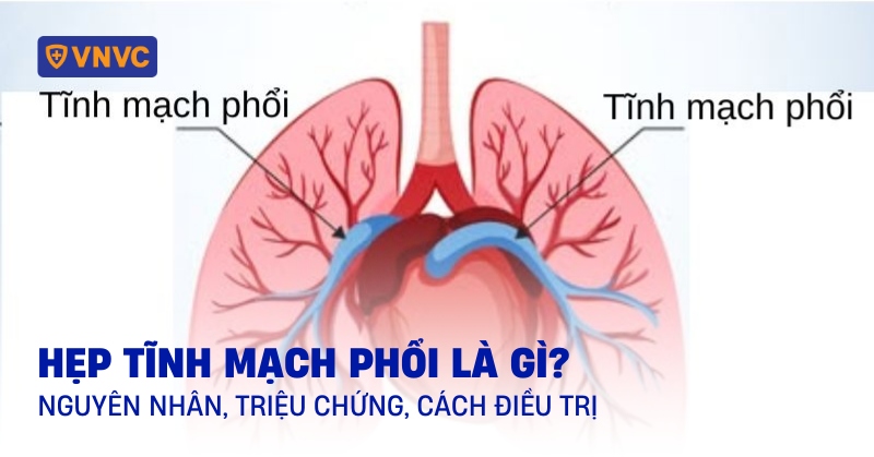 hẹp tĩnh mạch phổi là gì