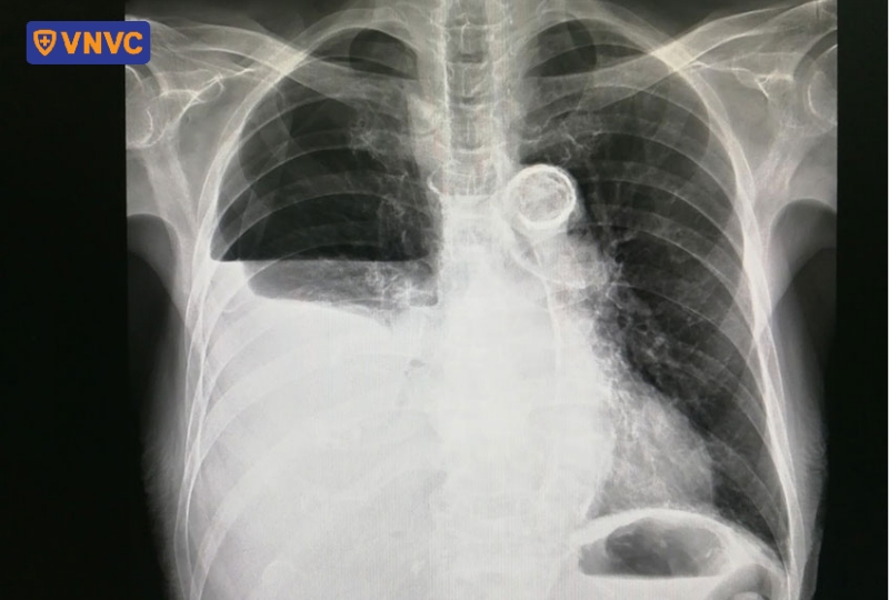 hình ảnh x quang chẩn đoán cơn đau phổi