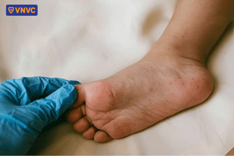 lòng bàn chân nổi mẩn đỏ