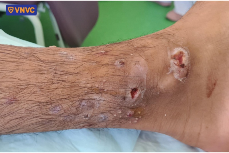 mụn mủ ở chân do bạch hầu