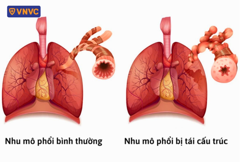 nhu mô phổi bình thường và tái cấu trúc