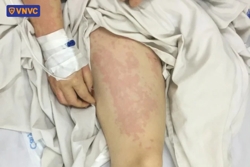 phát ban sau tiêm phòng uốn ván