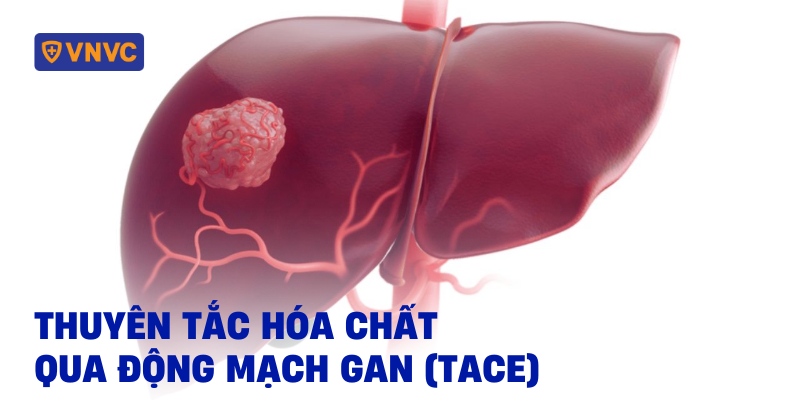 thuyên tắc hóa chất qua động mạch gan