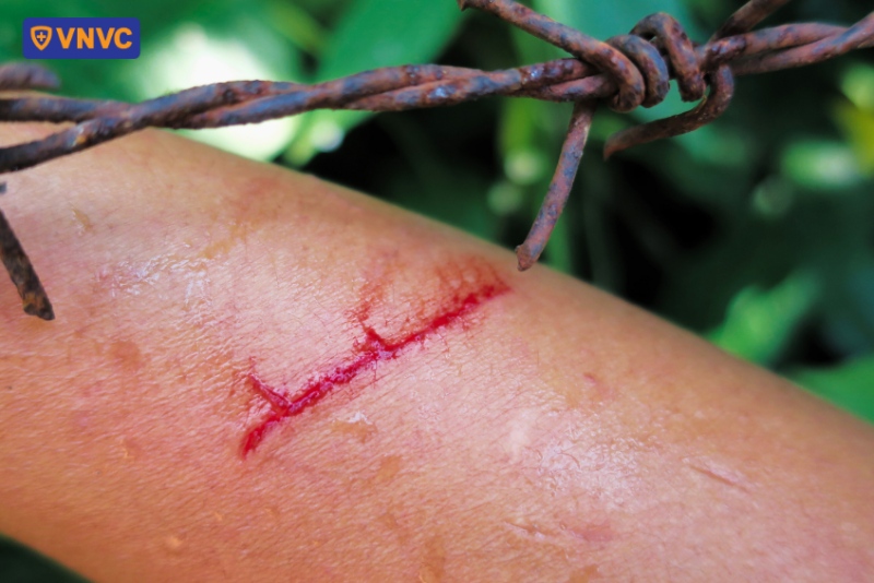 trầy xước do kẽm gai