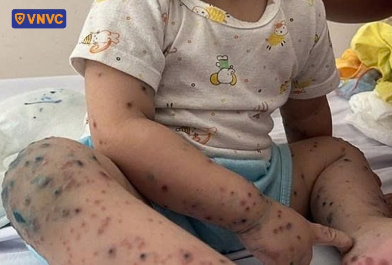 trẻ bị tay chân miệng