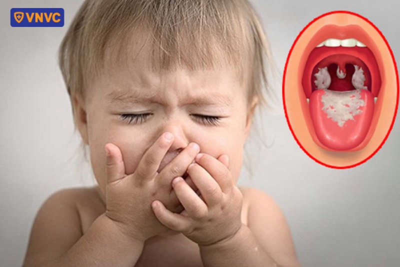 trẻ mắc bệnh bạch hầu