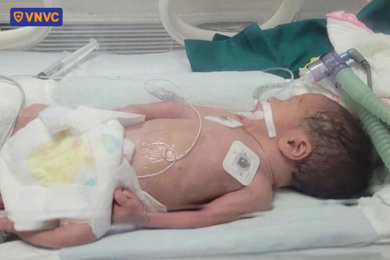 trẻ nhiễm phế cầu khuẩn biến chứng viêm phổi