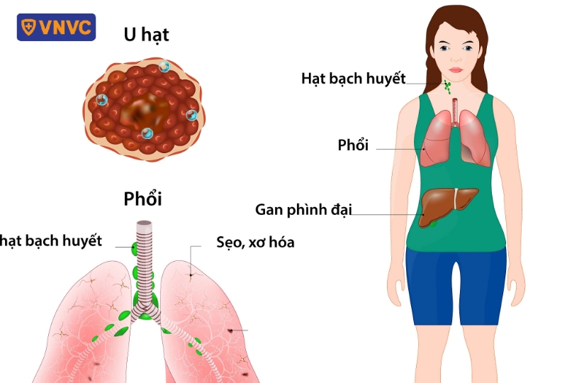 u hạt phát triển trong cơ thể
