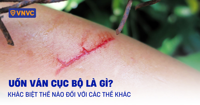 uốn ván cục bộ
