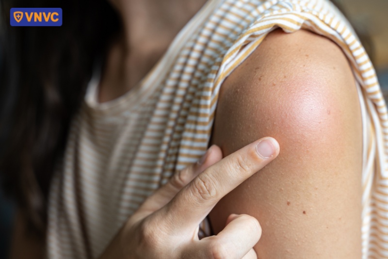 vết tiêm uốn ván bị sưng