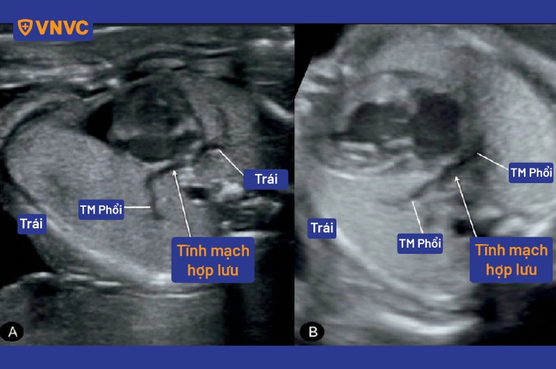 x quang tĩnh mạch bất thường hồi lưu