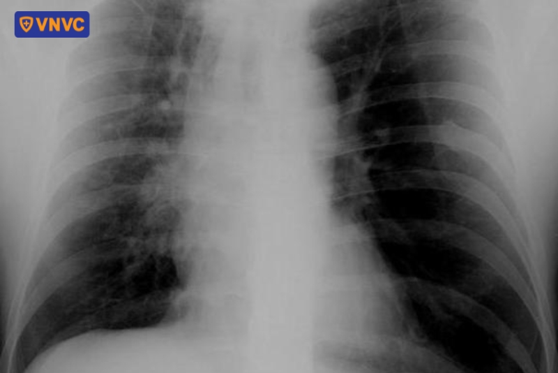 chụp xquang rốn phổi đậm