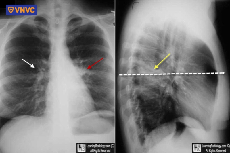 đọc chẩn đoán rốn phổi đậm
