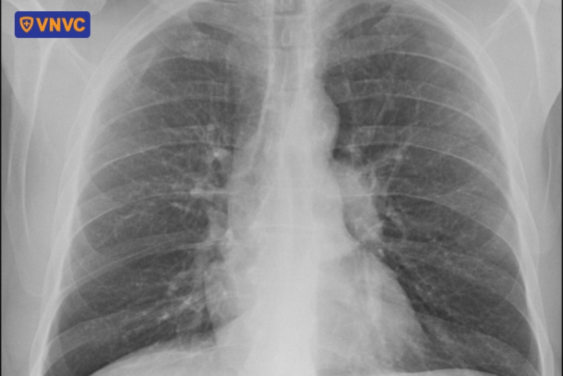 hình ảnh rốn phổi đậm trên xquang