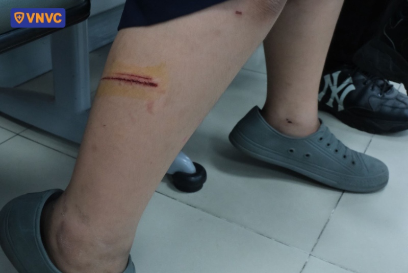 vết thương ở chân